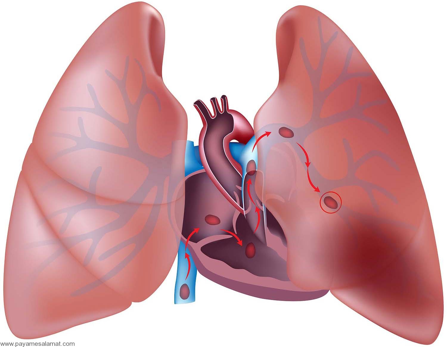 آمبولی ریه را بهتر بشناسید