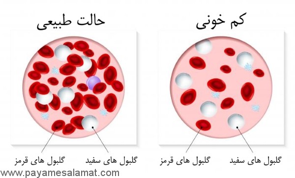 آیا می دانید کم خونی چیست و چه علائمی دارد؟