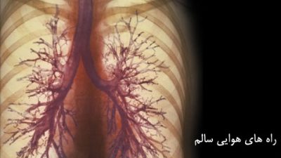 بیماری انسدادی مزمن ریوی COPD