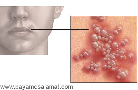 علائم اولیه تب خال لب و دهان و تب خال تناسلی