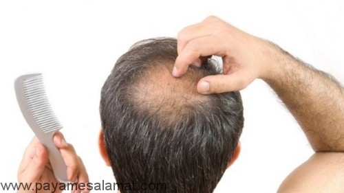 درمان خوراکی ریزش موها