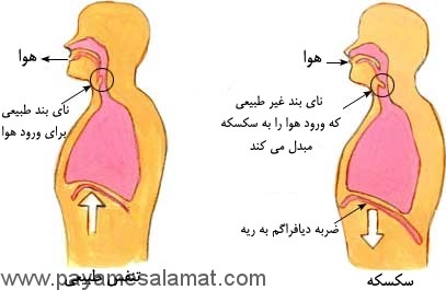 درمان سکسکه