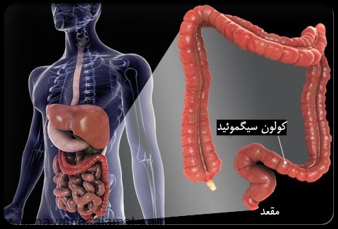 علائم سرطان روده بزرگ