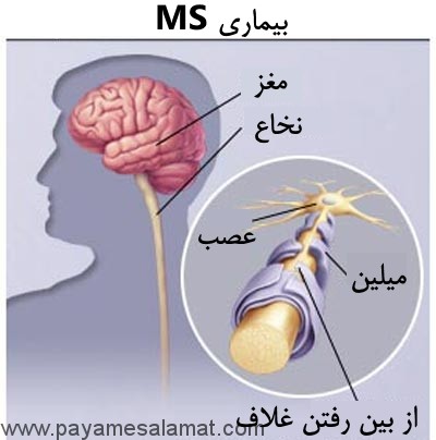 اطلاعات مفید در مورد بیماری MS