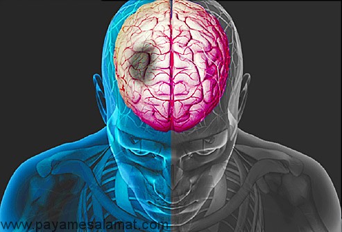 انواع سکته مغزی و علل ایجاد آنها