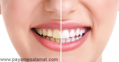 راه های ساده و خانگی برای سفید کردن دندان ها