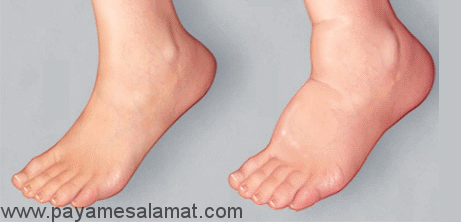ورزش مناسب برای جلوگیری از تورم مچ پا