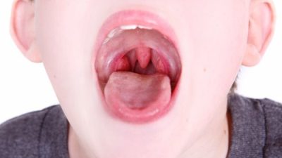 تورم زبان کوچک علل، علائم و درمان های خانگی