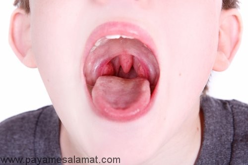 تورم زبان کوچک علل، علائم و درمان های خانگی