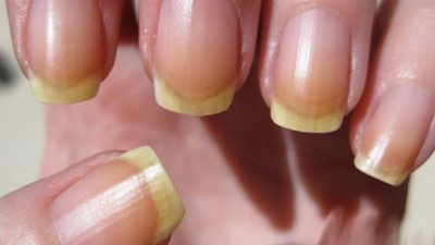علل زردی ناخن دست و پا و درمان های طبیعی آن