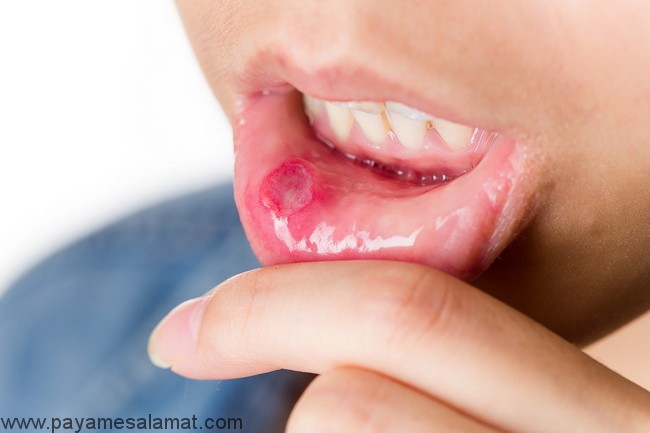 برجستگی های دهان علل، علائم و درمان های طبیعی