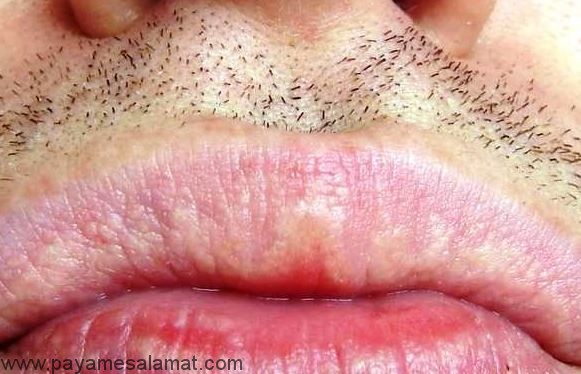 علائم و علل ایجاد دانههای فوردایس (Fordyce) و درمان های موثر آن