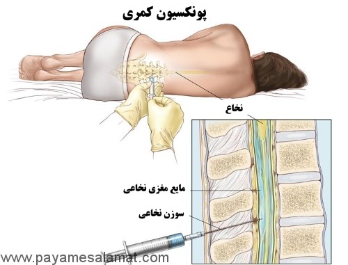 علائم و عوامل خطر ابتلا به لوسمی لنفوسیتی حاد
