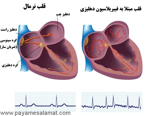 بررسی اجمالی فیبریلاسیون دهلیزی