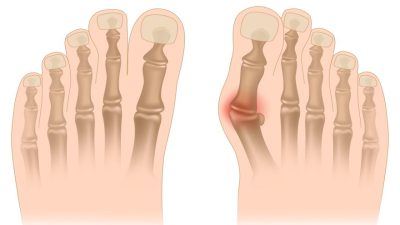 چگونه از درد پینه پا بدون جراحی خلاص شویم؟