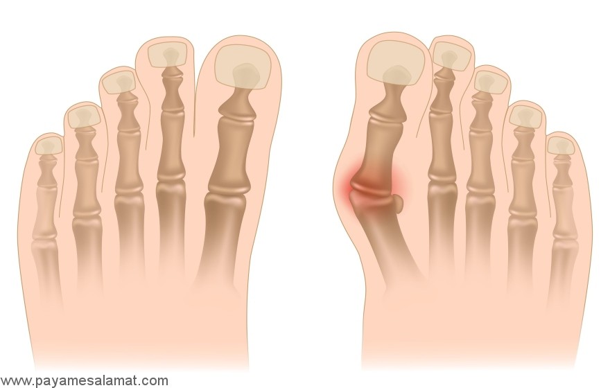 چگونه از درد پینه پا بدون جراحی خلاص شویم؟