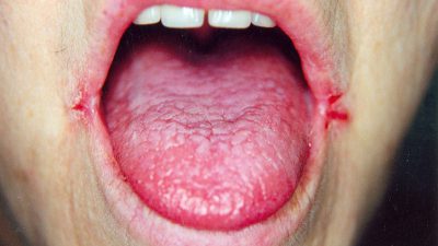 درمان های خانگی ترک گوشه دهان