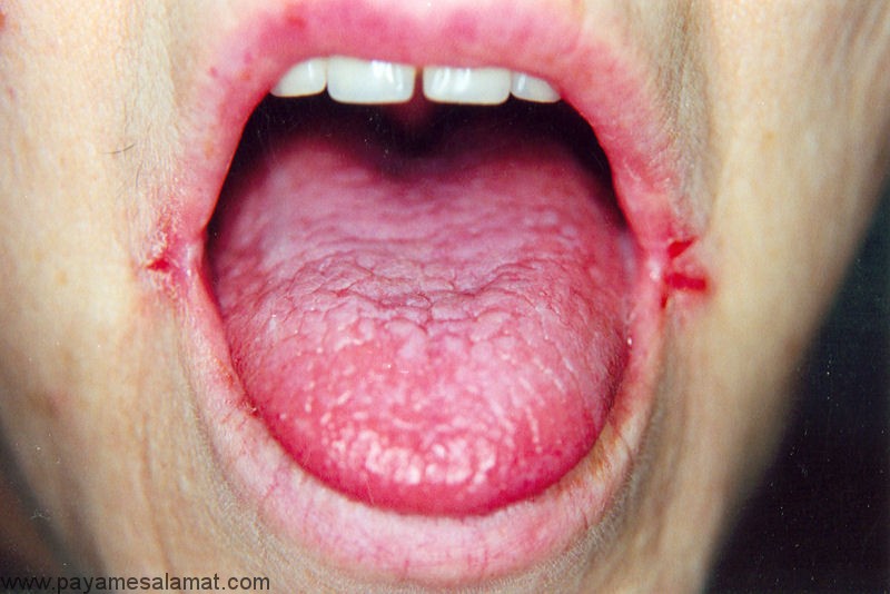 درمان های خانگی ترک گوشه دهان