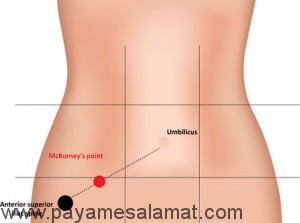 درد پایین شکم سمت راست مک برنی McBurney’s درد پایین شکم سمت راست مک برنی McBurney’s