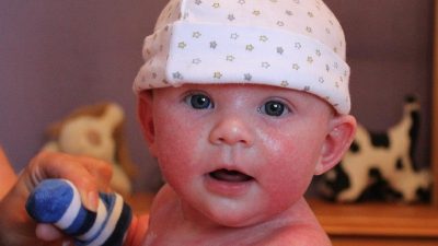 علت اگزما در نوزادان و کودکان و علائم آن