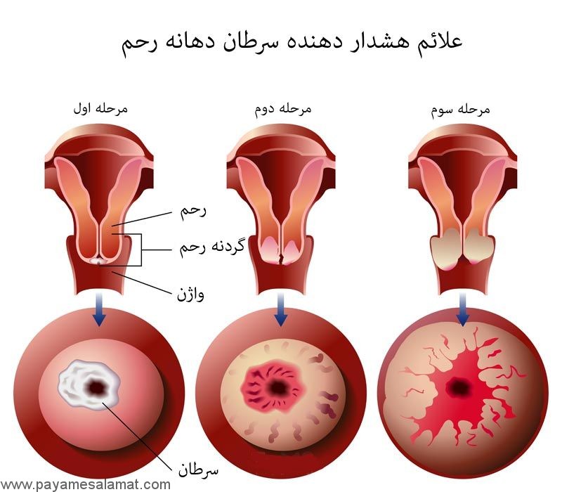 علائم سرطان دهانه رحم که نباید نادیده بگیرید