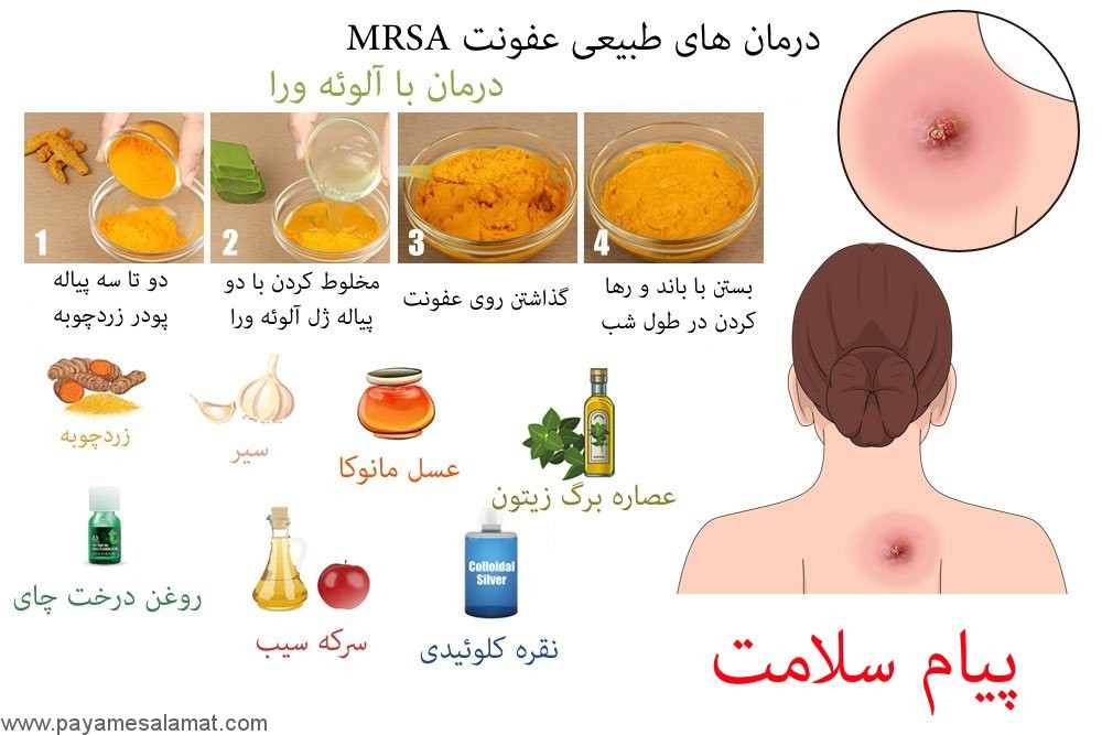 درمان های طبیعی عفونت MRSA (استافیلوکوکوس اورئوس مقاوم به متی سیلین)