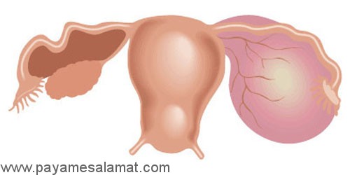 انواع کیست های تخمدان و علائمی که نباید در مورد آن ها نادیده گرفته شود