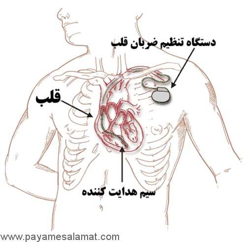 آشنایی با دستگاه تنظیم ضربان قلب (باطری قلب)