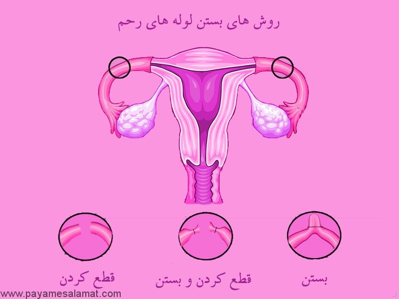 روش های بستن لوله های رحم