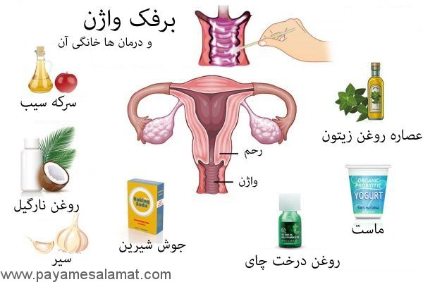برفک واژن و درمان های خانگی برای آن