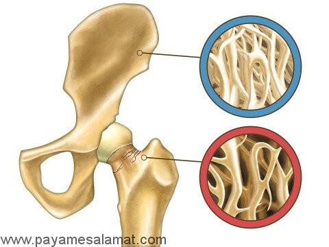 کمبود کلسیم یا بیماری هیپوکلسمی چیست و چه علائمی دارد؟