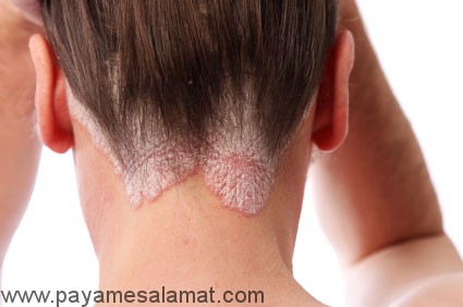 پسوریازیس چیست و برای درمان آن چه داروهای به کار برده می شود؟