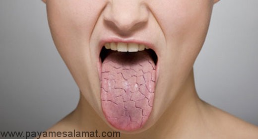 علت خشکی دهان چیست و چگونه درمان می شود؟