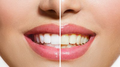 علت تغییر رنگ دندان چیست و چگونه می تواند از تیره شدن دندان ها جلوگیری کرد