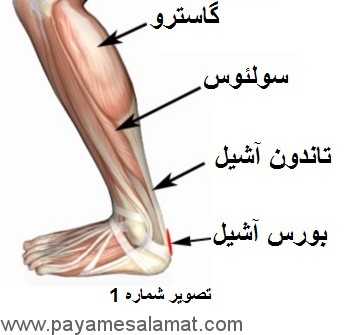 علل و درمان درد تاندون آشیل