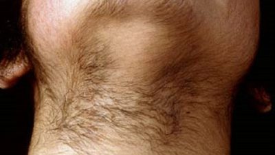 علل و درمان موثر هیرسوتیسم یا رشد موهای زائد در زنان