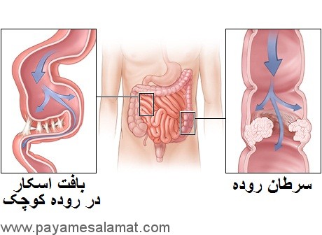 انسداد روده چیست؟ چه نشانه ها و علتی دارد؟