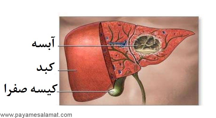 علل، انواع، علائم و درمان آبسه کبدی