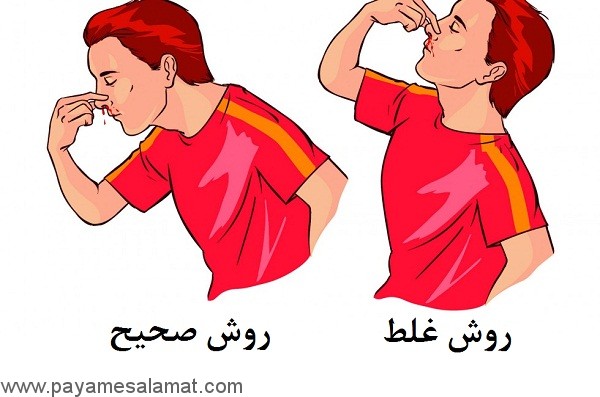 خون دماغ یا خونریزی از بینی، علائم، علل، درمان و پیشگیری