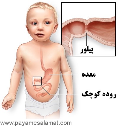 نشانه ها، علل و عوامل ایجاد کننده تنگی پیلور در نوزادان و درمان این بیماری
