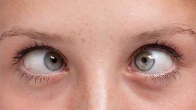علائم، علل و درمان های انحراف چشم