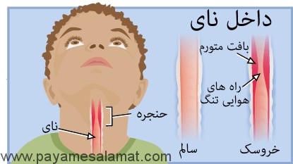 خروسک در کودکان با لارنگوتراکئوبرونشیت و درمان ها خانگی آن