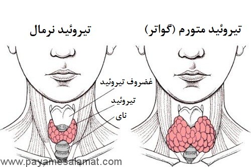 گواتر چیست و چه علائمی دارد؟