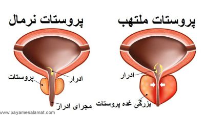 انواع و علل ابتلا به التهاب غده پروستات یا پروستاتیت
