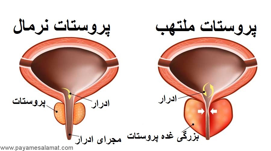 انواع و علل ابتلا به التهاب غده پروستات یا پروستاتیت