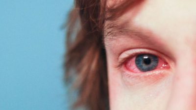 آلرژی چشم چیست و چه نشانه هایی دارد؟