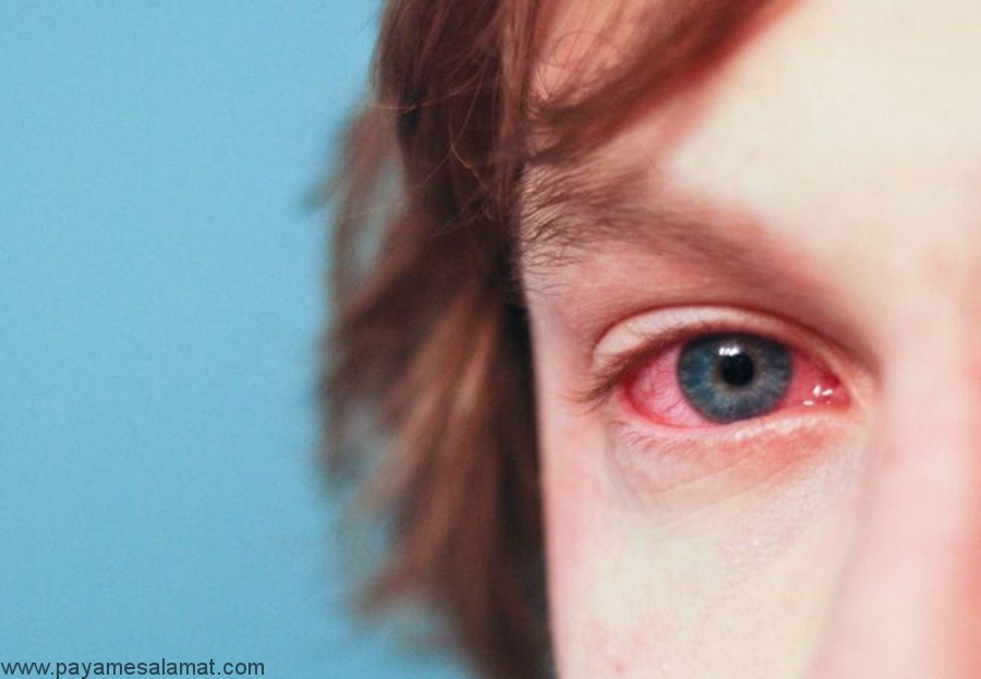 آلرژی چشم چیست و چه نشانه هایی دارد؟