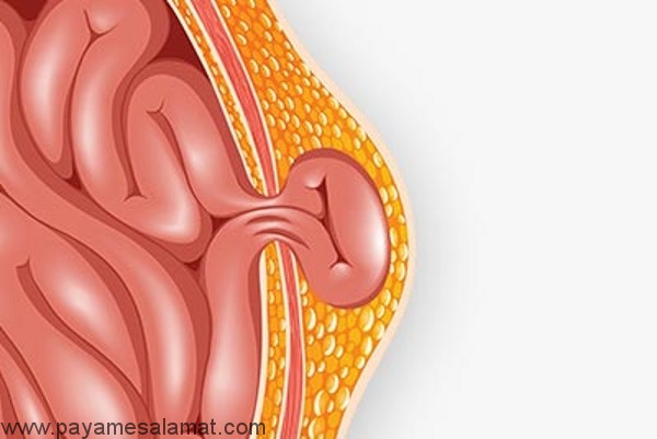 نشانه ها و درمان فتق بعد از سزارین