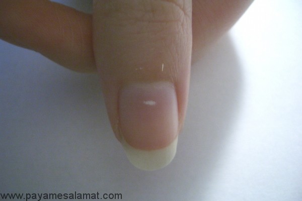 علت وجود لکه های سفید روی ناخن ها (Leukonychia) و درمان آن