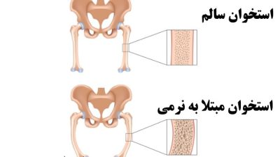 نرمی استخوان (استئومالاسی) از علت و علائم تا درمان